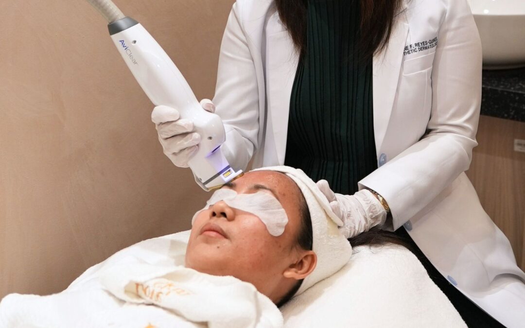 The Solution to Your Acne: Meet Acne Escape by AviClear